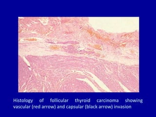 Histology of follicular thyroid carcinoma showing
vascular (red arrow) and capsular (black arrow) invasion
 