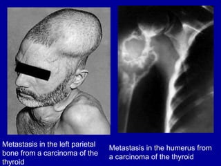Metastasis in the humerus from
a carcinoma of the thyroid
Metastasis in the left parietal
bone from a carcinoma of the
thyroid
 