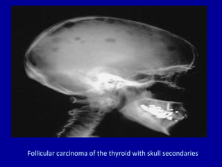 Follicular carcinoma of the thyroid with skull secondaries
 