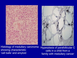 Hyperplasia of parafollicular C
cells in a child from a
family with medullary cancer
Histology of medullary carcinoma
showing characteristic
‘cell balls’ and amyloid
 