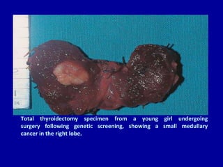 Total thyroidectomy specimen from a young girl undergoing
surgery following genetic screening, showing a small medullary
cancer in the right lobe.
 