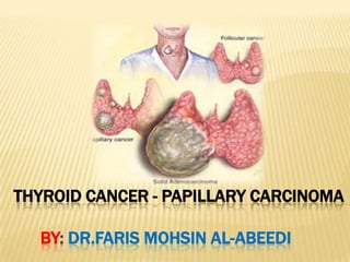 THYROID CANCER - PAPILLARY CARCINOMA

  BY: DR.FARIS MOHSIN AL-ABEEDI
 