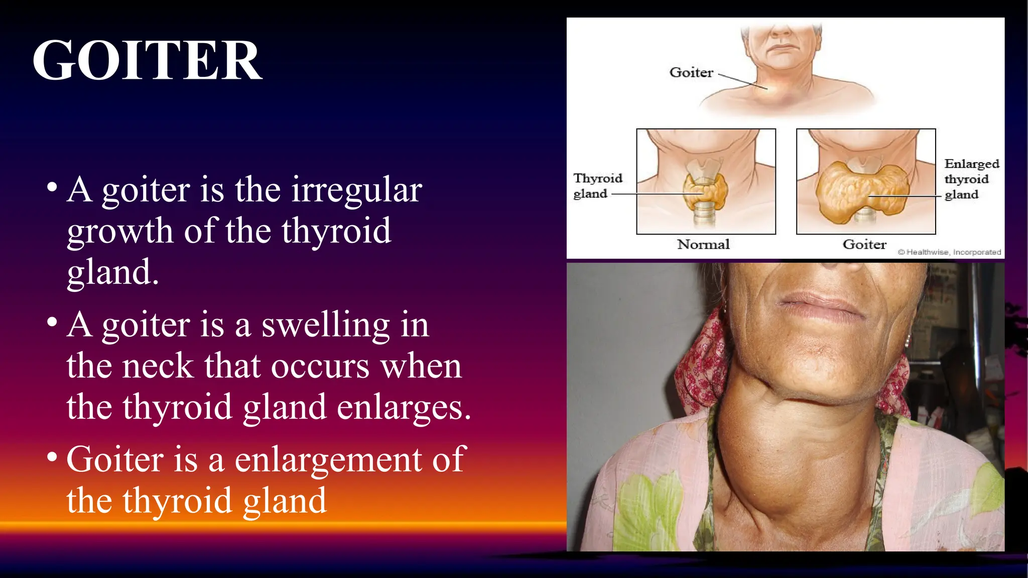 Goiter Approach Nursing Management of patient with Endocrine disorder | PPTX