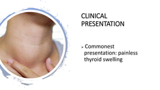 CLINICAL
PRESENTATION
 Commonest
presentation: painless
thyroid swelling
 