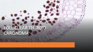 FOLLICULAR THYROID
CARCINOMA
 