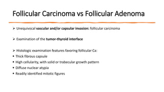 Follicular Carcinoma vs Follicular Adenoma
 Unequivocal vascular and/or capsular invasion: follicular carcinoma
 Examination of the tumor-thyroid interface
 Histologic examination features favoring follicular Ca:
 Thick fibrous capsule
 High cellularity, with solid or trabecular growth pattern
 Diffuse nuclear atypia
 Readily identified mitotic figures
 