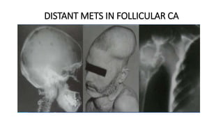 DISTANT METS IN FOLLICULAR CA
 