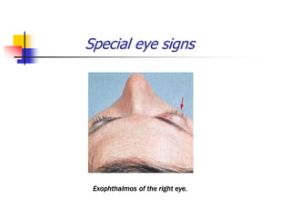 Special eye signs
Exophthalmos of the right eye.
 