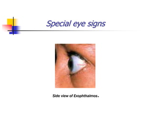 Special eye signs
Side view of Exophthalmos.
 
