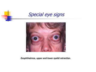 Special eye signs
Exophthalmos, upper and lower eyelid retraction.
 