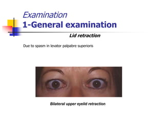 Examination
1-General examination
Lid retraction
Due to spasm in levator palpabre superioris
Bilateral upper eyelid retraction
 