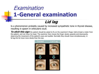 Examination
1-General examination
Lid lag
Is a phenomenon probably caused by increased sympathetic tone in thyroid disease,
resulting in spasm in orbicularis oculi.
To elicit this sign the patient should be asked to fix on the examiner's finger, held at least a meter from
the patient, and not move his head. The examiner then moves the finger slowly upwards and downwards,
observing the movement of the patient's eyes and eyelids. Normally they should move simultaneously; in
lid lag the lid move more slowly than the eye.
 