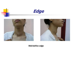 Edge
Well-define edge
 