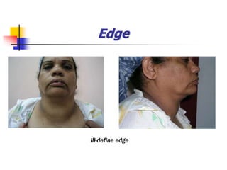 Edge
Ill-define edge
 