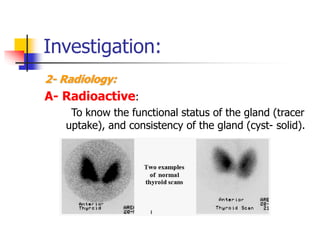 Investigation:
2- Radiology:
A- Radioactive:
To know the functional status of the gland (tracer
uptake), and consistency of the gland (cyst- solid).
 