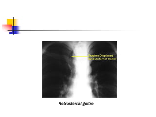 Retrosternal goitre
 