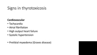 Signs in thyrotoxicosis
Cardiovascular
• Tachycardia
• Atrial fibrillation
• High output heart failure
• Systolic hypertension
• Pretibial myxedema (Graves disease)
 