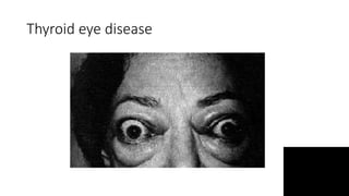 Thyroid eye disease
 