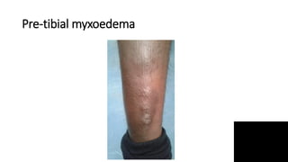 Pre-tibial myxoedema
 