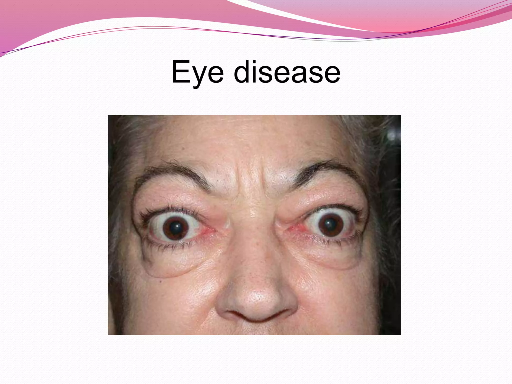 Eye disease
 