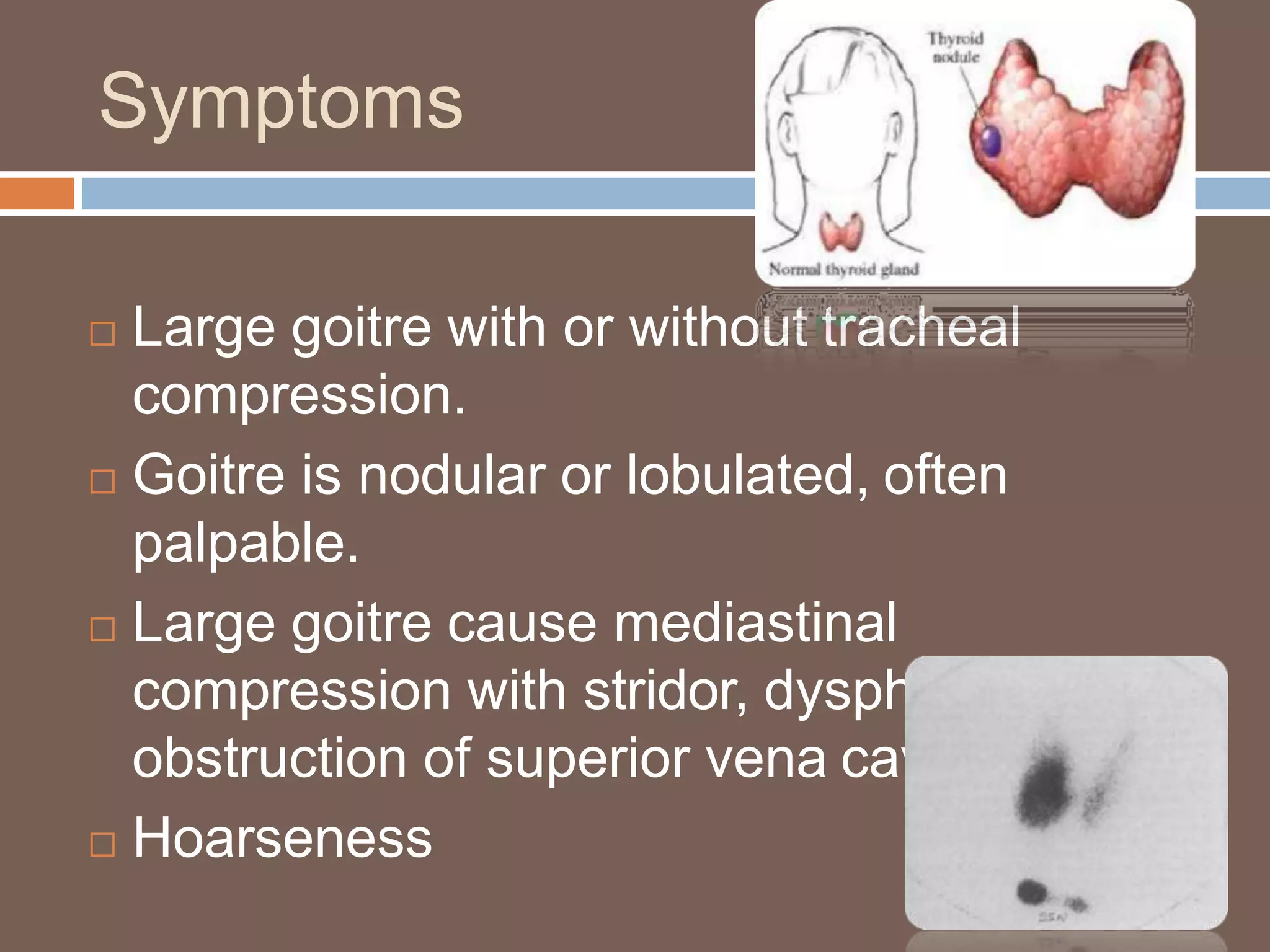 Symptoms
 Large goitre with or without tracheal
compression.
 Goitre is nodular or lobulated, often
palpable.
 Large goitre cause mediastinal
compression with stridor, dysphagia and
obstruction of superior vena cava.
 Hoarseness
 