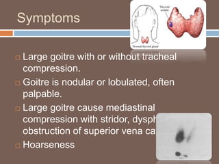 Symptoms
 Large goitre with or without tracheal
compression.
 Goitre is nodular or lobulated, often
palpable.
 Large goitre cause mediastinal
compression with stridor, dysphagia and
obstruction of superior vena cava.
 Hoarseness
 