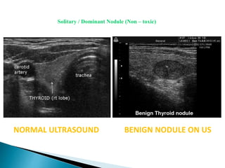 NORMAL ULTRASOUND BENIGN NODULE ON US
Solitary / Dominant Nodule (Non – toxic)
 