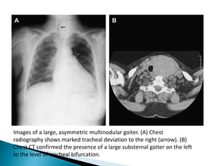 Images of a large, asymmetric multinodular goiter. (A) Chest
radiography shows marked tracheal deviation to the right (arrow). (B)
Chest CT confirmed the presence of a large substernal goiter on the left
to the level of tracheal bifurcation.
 