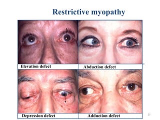 27
Restrictive myopathy
Elevation defect Abduction defect
Depression defect Adduction defect
 
