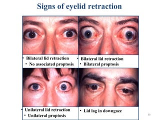 30
Signs of eyelid retraction
• Bilateral lid retraction
• No associated proptosis
• Bilateral lid retraction
• Bilateral proptosis
• Lid lag in downgaze• Unilateral lid retraction
• Unilateral proptosis
 