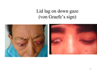 31
Lid lag on down gaze
(von Graefe’s sign)
 