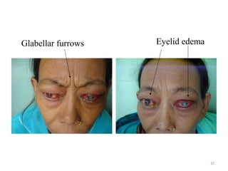 32
Glabellar furrows Eyelid edema
 