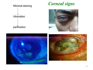 34
Minimal staining
Ulceration
perforation
Corneal signs
 