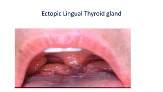 Ectopic Lingual Thyroid gland
 