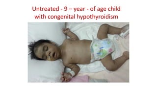 Untreated - 9 – year - of age child
with congenital hypothyroidism
 