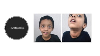 Thyrotoxicosis
 