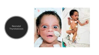 Neonatal
Thyrotoxicosis
 
