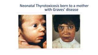 Neonatal Thyrotoxicosis born to a mother
with Graves’ disease
A Color Atlas of Endocrinology p51
 