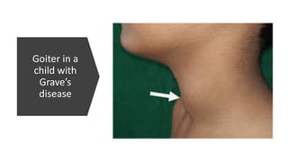 Goiter in a
child with
Grave’s
disease
 