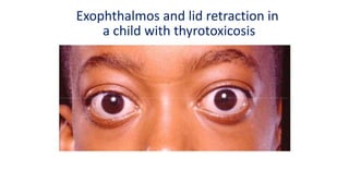 Exophthalmos and lid retraction in
a child with thyrotoxicosis
 
