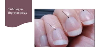 Clubbing in
Thyrotoxicosis
 