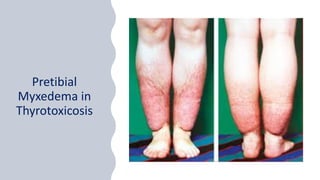 Pretibial
Myxedema in
Thyrotoxicosis
 