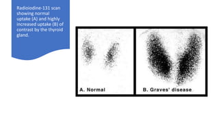 Radioiodine-131 scan
showing normal
uptake (A) and highly
increased uptake (B) of
contrast by the thyroid
gland.
 