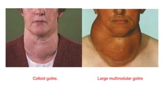 Colloid goitre. Large multinodular goitre
 