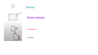 Graves disease
Toxic adenoma
Toxic MNG
Normal
 
