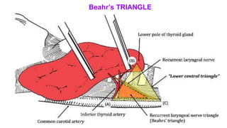 Beahr’s TRIANGLE
 
