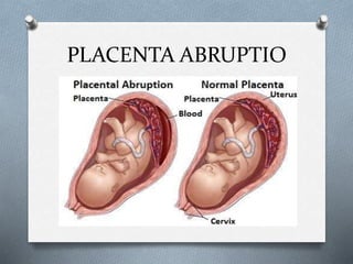 PLACENTA ABRUPTIO
 