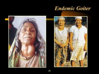 26 
Endemic Goiter 
 
