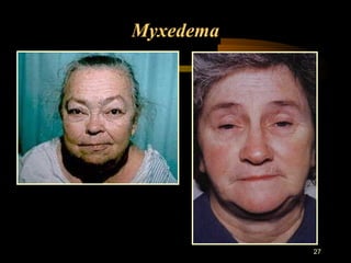 27 
Myxedema 
 