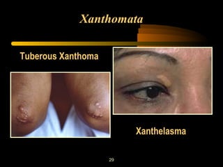 Xanthomata 
29 
Xanthelasma 
Tuberous Xanthoma 
 
